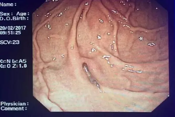 医生惊呆！男子生吞野猪胃里寄生虫：结果恐怖