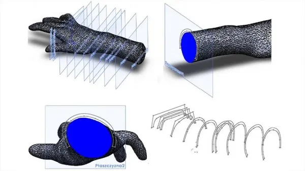 3D打印定制矫形器帮助手部残疾男子实现抓握动作