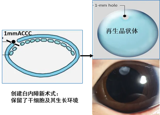 中国生命科学领域十大进展：婴幼儿白内障全新治疗策略