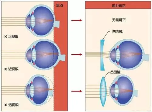 有一点点近视 到底要不要戴眼镜呢？