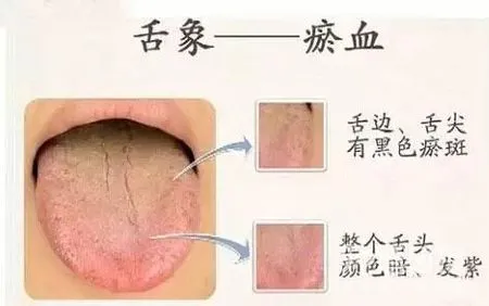 流言揭秘：舌头上长黑点是癌症吗？考虑体内淤血存在