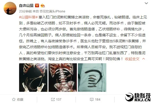 男子将5条泥鳅1条黄鳝塞入肚中：CT画面是这个样子