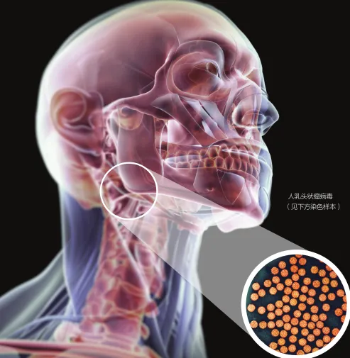 男性也需接种HPV疫苗 喉癌舌癌正在男性中暴发