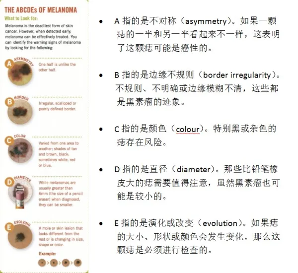 5个小贴士：通过观察痣判断皮肤癌