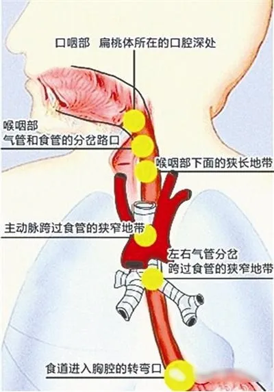 鱼刺卡喉猛吞饭 刺没咽下一死两伤