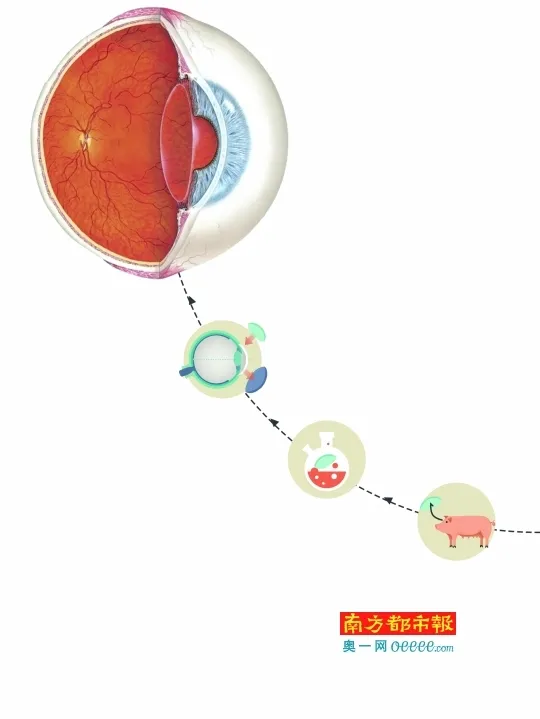 14岁少年移植“猪角膜”：世界亮了