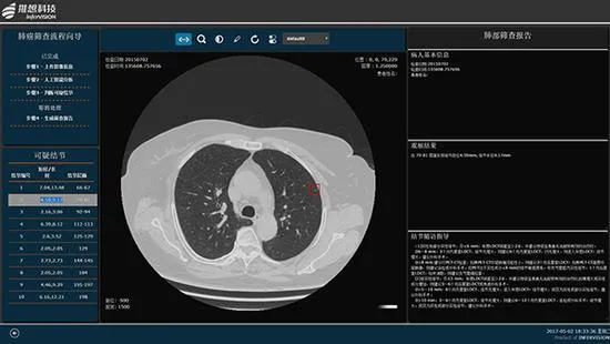 人工智能辅助筛查肺癌 帮医生减负，缓和医患矛盾