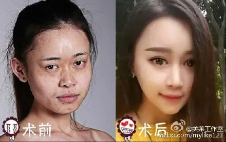 女孩晒整形日记变网红：“凤姐”变“Angelababy”