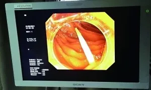 大爷囫囵吞下整个香菇 腹痛三天小肠被切