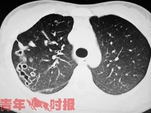 23岁姑娘肺里长满“隧道洞”咳血：CT一看全是虫