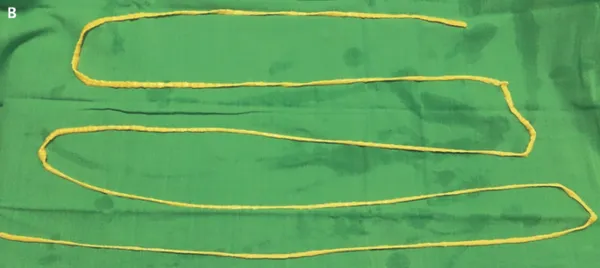 [视频]高能慎入：印度医生从患者口中取出 6 英尺长的绦虫