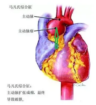 号称“天才病”的马凡氏综合征，究竟是什么？